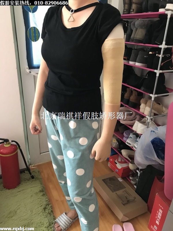 北京瑞褀祥假肢厂,为患者安装上臂假肢手